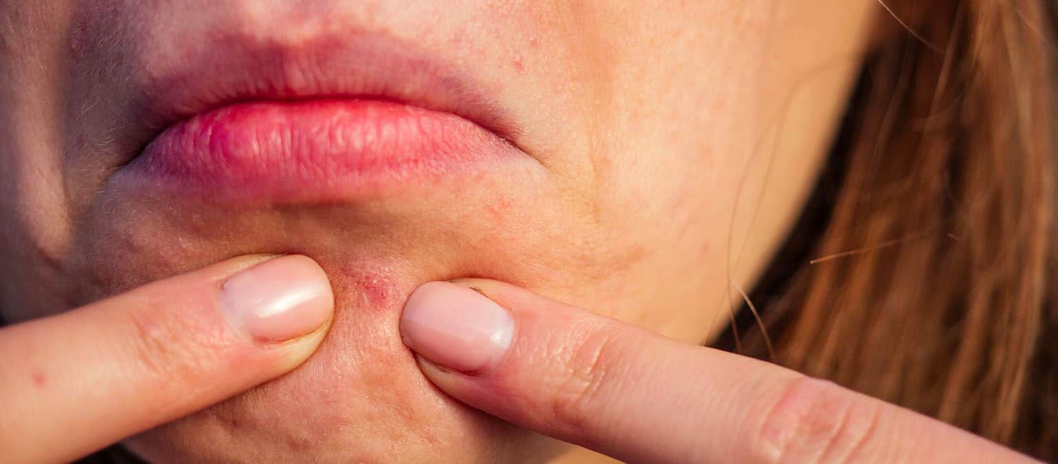 Menopausal Acne How You Can Treat It GenM