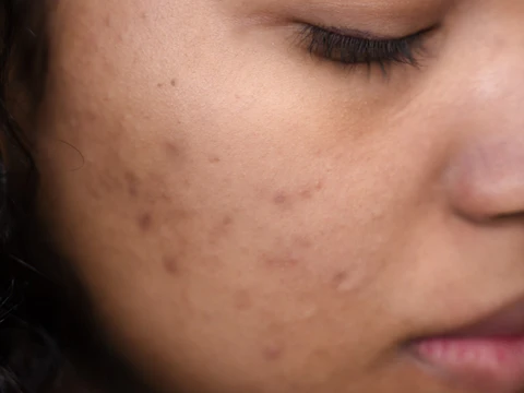 A Nutritionist’s Guide To Hormonal Acne
